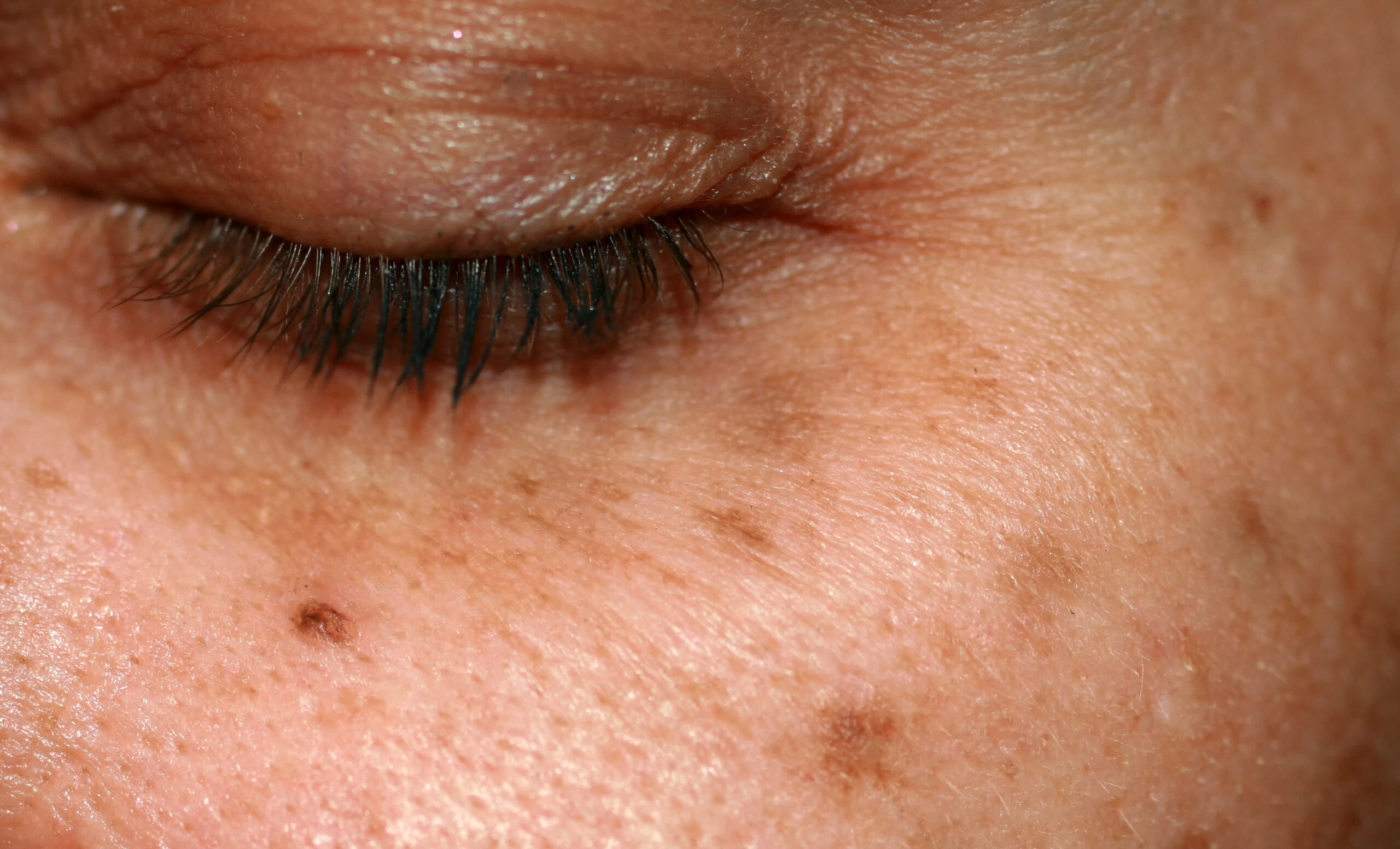 Age spots on the face